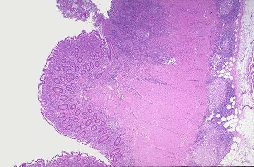 Gambar A.3. Gambaran mikroskopis peradangan transmural pada penyakit Crohn.