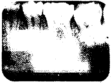 Gambar 12 : Gambaran artefak dan Sinus Maksillaris 1. Gambaran artefak berupa garis radiopag disebabkan hasil radiografi tergores setelah prosessing. 2.