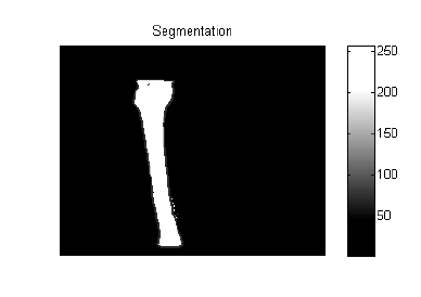 Pada gambar 8 memperlihatkan bahwa hasil segmentasi telah memisahkan objekobjek citra yang tidak diperlukan dimana citra yang membentuk tulang telah terpisah dari citra yang membentuk daging.