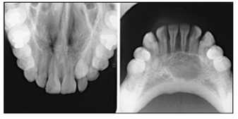 c. Radiografi Oklusal Radiografi Oklusal adalah radiografi yang digunakan untuk melihat anatomi tulang maksilla maupun mandibula dengan area yang luas dalam satu film.