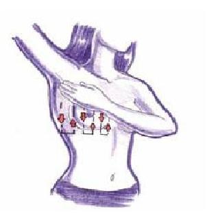 31 3) Periksa payudara dengan menggunakan Vertical Strip dan Pemutaran (Gambar 8). Gambar 8. SADARI dengan Vertical Strip a.