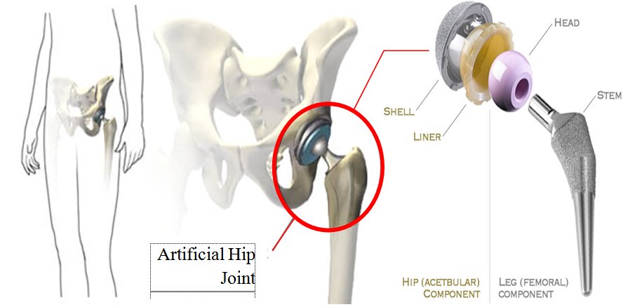2 permukaan tulang rawan hip joint bergelombangan dan tidak rata.