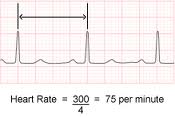 Gambar 2.4. Cara Menghitung Frekuensi Jantung dengan Metode 300 dibagi dengan Jumlah Kotak Besar dari R-R Sumber: www.nottingham.ac.uk 3.