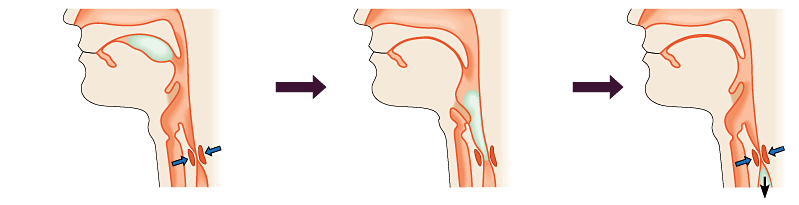 Tongue Bolus of food Epiglottis up Epiglottis down Pharynx Larynx Trachea (windpipe) Esophageal sphincter Esophagus Larynx up Esophagus