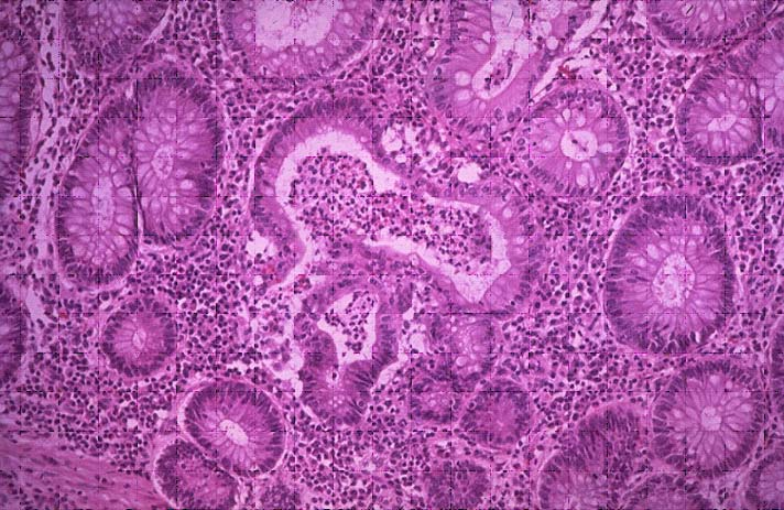 epitel absortif banyak,inti dibasal,goblet sel banyak dan clear epithel. Dalam perjalanan penyakit, kolitis ulserosa dibagi dalam 3 tahap yaitu: 1. Kolitis ulserosa dini aktif; 2.