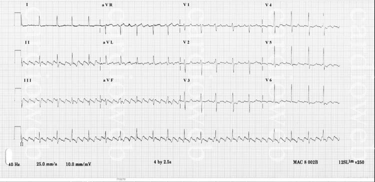 53 - Interval PR biasanya teratur, tetapi dapat juga bervariasi. - Kompleks QRS normal. Contoh: Gambar 2.24a EKG Atrial Flutter 1:1 (direkam dari seorang wanita berumur 72 tahun) (Sumber: http://www.