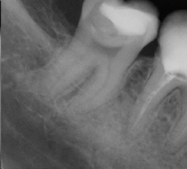 ukuran, arah akar dan saluran akar), celah ligament periodontal dan tulang disekitarnya (gambar 1).