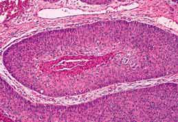 7 Gambar 2.4 Squamous cell carcinoma ( dikutip dari Eble et al, 2004) Gambar 2.