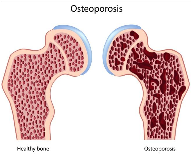 BAB II PENCEGAHAN OSTEOPOROSIS PADA USIA DEWASA 1.1 Perihal Osteoporosis 2.1.1 Definisi Osteoporosis Kata osteoporosis berasal dari bahasa yunani yaitu osteo yang berarti tulang dan porous yang berarti keropos.