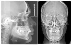 4. Evaluasi hasil sebelum dan sesudah perawatan ortodonti. 5. Perkiraan arah pertumbuhan. 6.