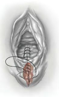 Jahitan Otot Lanjutkan jahitan pada daerah otot perineum sampai ujung luka pada perineum secara jelujur dengan bena 2-0 Lihat ke