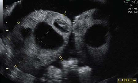 Sonogram pelvis mungkin sulit menginterpretasi uterus, adnexa dan struktur sekelilingnya jika ada massa