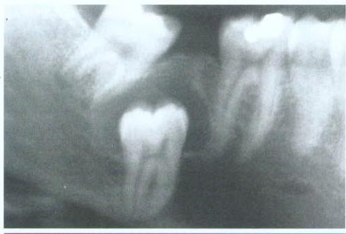11 Gambar 2.1. Kista Dentigerous. Tipe sentral menunjukan mahkota terproyeksi kedalam rongga kista. Sumber : Oral & Maxillofacial Pathology. 2 nd. (1) 2.