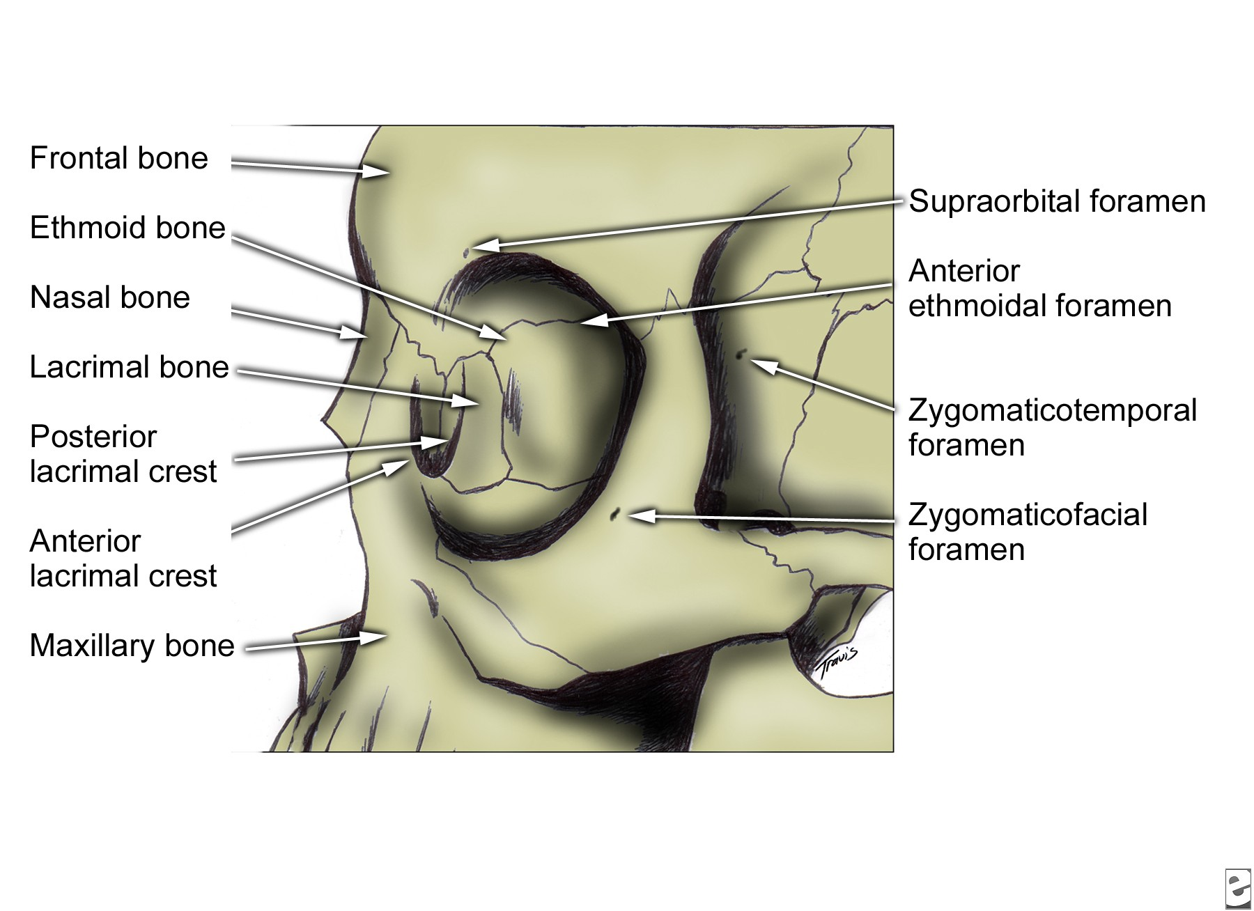 5 tulang zigoma (dari lateral) Tulang Frontal Tulang frontal membentuk bagian anterior tempurung kepala,