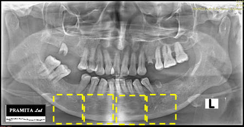 Navastara, Anggraeni, dan Arifin Pengukuran Ketebalan Tulang Kortikal pada Citra Panorama Gigi Berbasis Model Metode line operator bekerja seperti operasi konvolusi citra, yaitu menggunakan sebuah
