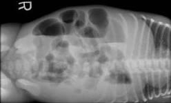 enterokolitis nekrotikans neonatal. Foto polos abdomen dapat menyingkirkan diagnosis lain seperti peritonitis intrauterine ataupun perforasi gaster.
