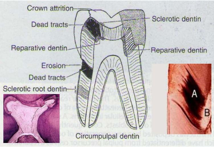 dalam membentuk dentin, maka tubulus dentin berhubungan dengan dentin primer ke dentin sekunder dan dentin tertier, maka jalan masuk ke pulpa masih terbuka.