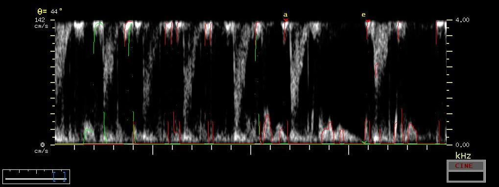 24 Vpeak Katup (cm/s) Gambar 13. Histogram nilai rataan peak velocity (cm/s) di katup semilunar aorta dengan PWD echocardiography. V peak Gambar 14.