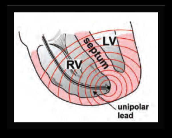 implantasi PJ di ventrikel kanan, aktivasi ventrikel kiri akan dimulai dari septum interventrikel lalu menuju dinding bebas ventrikel kiri.