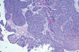 Gambar 2.2. Karsinoma sel skuamosa, non-keratinizing. Pulau-pulau sel-sel tumor kohesif menginvasi ke dalam stroma dibawahnya. Permukaan karsinoma in situ terlihat (Barnes et al, 2005) 2.3.