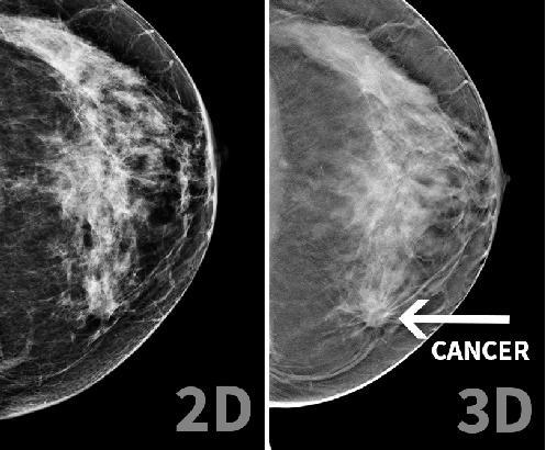 Diluar dari perbedaan pendapat antara yang pro dan kontra, faktanya, mammografi ini banyak direkomendasikan oleh para dokter di berbagai belahan dunia saat ini.