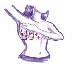 25 (2) Tahap 2 Pemeriksaan payudara dengan vertical strip (a) Memeriksa seluruh bagian payudara dengan cara vertical, dari tulang selangka di bagian atas ke bra-line di bagian bawah, dan garis tengah