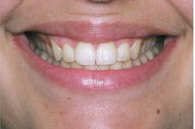 2.1.3.2 Bukal Koridor Bukal koridor adalah ruangan negatif lateral antara gigi posterior dan sudut mulut saat tersenyum (Gambar 2).