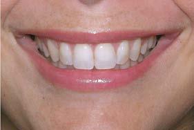 frush dan Fisher (1958) mengartikan bukal koridor sebagai ruangan antara permukaan fasial gigi posterior dan sudut bibir ketika pasien tersenyum.
