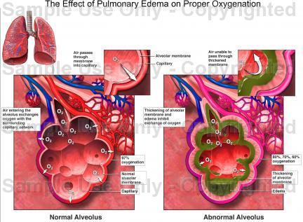 Manifestasi Klinis Gagal Jantung Akut Edema pulmoner Alveoli terisi oleh cairan serosa Penurunan efisiensi ventrikel kiri Peningkatan tekanan vena