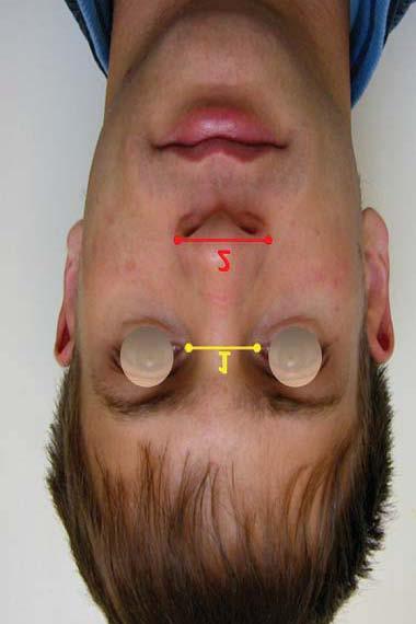 mulut (commissural) kiri ke kanan vermillion bibir ketika pasien dalam keadaan istirahat dengan bibir atas dan bawah menutup (Gambar