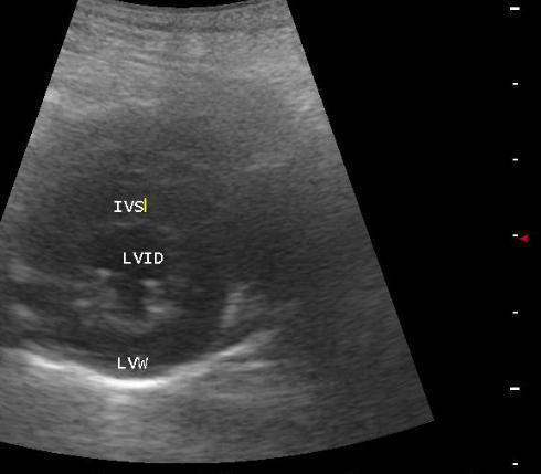 skala garis putih = 1 cm. Gambar 9 Pencitraan ekhokardiografi B-mode dengan endokardium tebal derajat ringan.