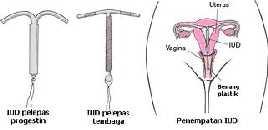 2.3.2 Jenis IUD Jenis IUD yang dipakai di Indonesia antara lain adalah : a. Copper-T IUD berbentuk T, terbuat dari bahan polyethelen dimana pada bagian vertikalnya diberi lilitan kawat tembaga halus.