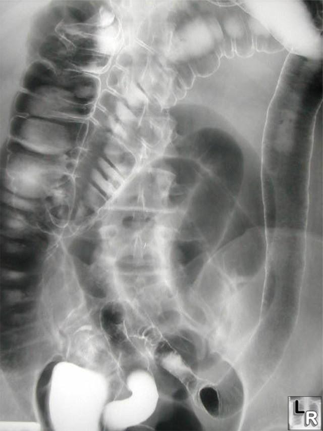 Ulcerative colitis: barium enema examination demonstrates loss of haustral folds in the entire descending colon with small