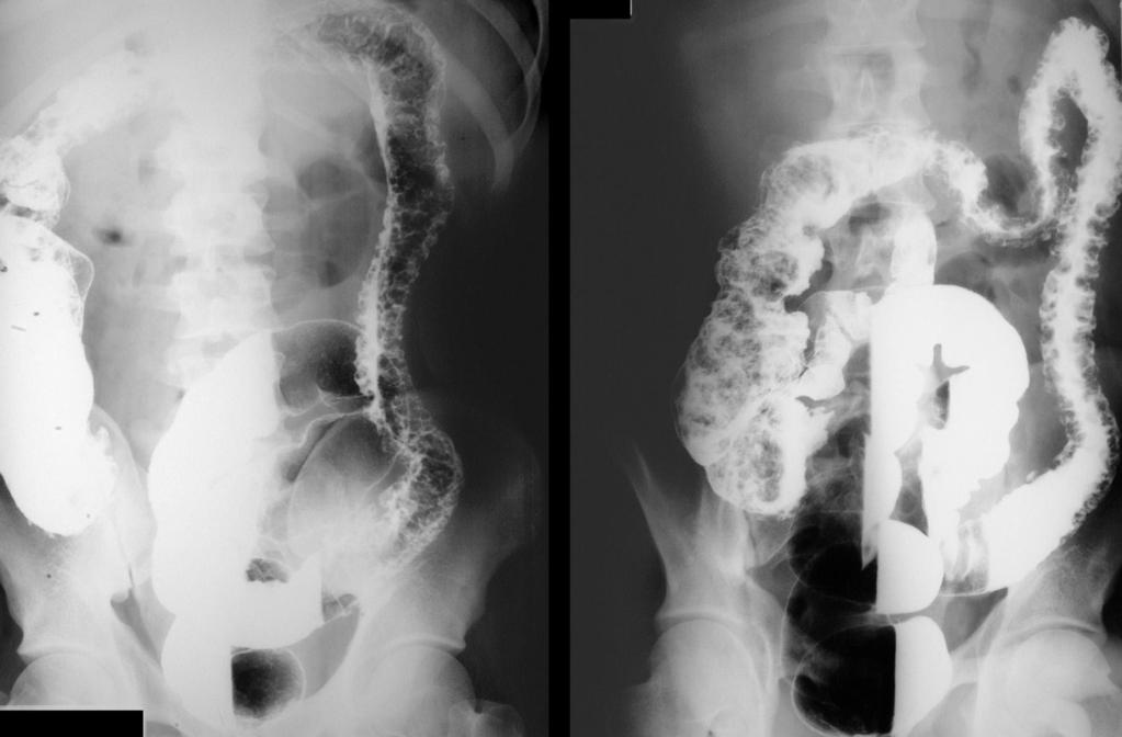 Double-contrast barium enema studies in a 44-year-old man known to have long