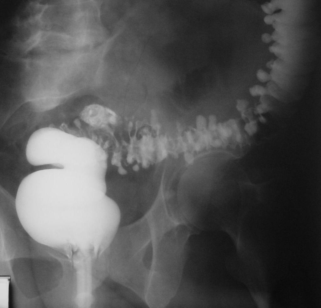 Single-contrast barium enema study in a patient with diverticulitis