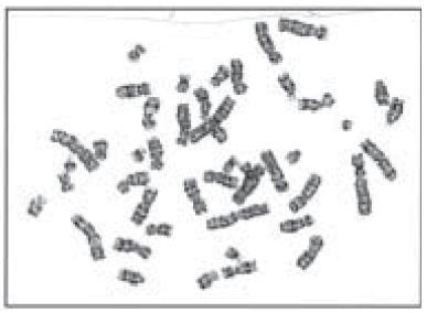 Tugas Review Kamla-Raj 2010 Int J Hum Genet, 10(1-3): 41-47 (2010) HASIL Hasil yang diamati dari studi kromosom. Tabel 1: Pengkategorian kasus klinis disebut (161) No.