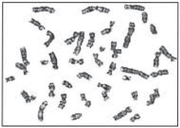 PEMBAHASAN Studi Kromosom dilakukan pada 161 kasus kelainan bawaan menunjukkan kromosom kelainan pada 91 kasus (56,52%) dengan trisomi 21 menjadi yang paling umum (78%).