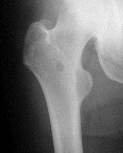 Gambar 5. Gambaran radiologi pada os femur dekstra.