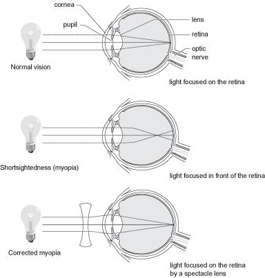 MIOPIA DEFINISI Miopia adalah suatu kelainan refraksi dimana sinar sejajar yang datang dari jarak tak terhingga, oleh mata dalam keadaan istirahat atau tanpa akomodasi, difokuskan didepan retina,