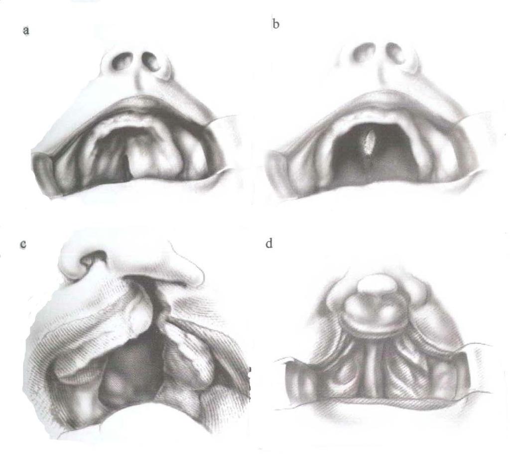 Gambar (3a). Incomplete cleft palate, (3b). Complete cleft palate, (3c). Unilateral complete cleft lip and palate, (3d). Bilateral cleft lip and palate.