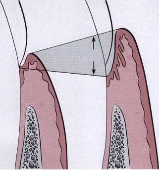 sulkus gingiva sebagai akibat dari pembesaran gingival. Tidak ada migrasi epitel junctional ke apikal atau resorpsi puncak tulang alveolar (Herbert, 2006). B.
