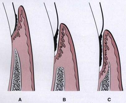 Ada dua jenis poket periodontal berdasarkan hubungannya dengan tulang crestal (shantypriya, 2008), yaitu: Berdasarkan hubungannya dengan tulang crestal a.