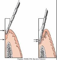 Gambar 2 : Tipe poket periodontal; A, poket gingiva, tidak ada kerusakan pada jaringan periodontal.