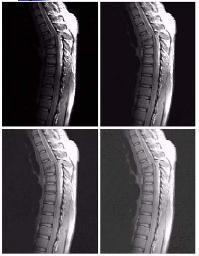 Sebuah image MRI (Magnetic Resonance Image) untuk tulang manusia. Image asli didominasi oleh warna gelap.