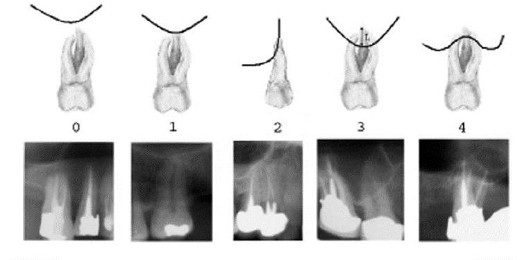 Klasifikasi 4: Lantai sinus maksilaris superior membungkus sebagian atau seluruh akar gigi Teknik klasifikasi 3 dan 4 pada radiografi panoramik menunjukkan gambaran sinus yang terproyeksi ke dinding