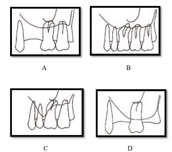 Gambar 6. Gambaran variasi morfologi sinus maksilaris dalam hubunganya dengan gigi geligi terdekat.