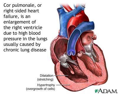 2.2 Kor Pulmonal (Penyakit Jantung Paru) 2.2.1 Defenisi Defenisi Kor Pulmonal menurut WHO (1963) adalah keadaan patologis dengan ditemukannya hipertropi ventrikel kanan yang disebabkan oleh kelainan fungsional dan struktur paru.