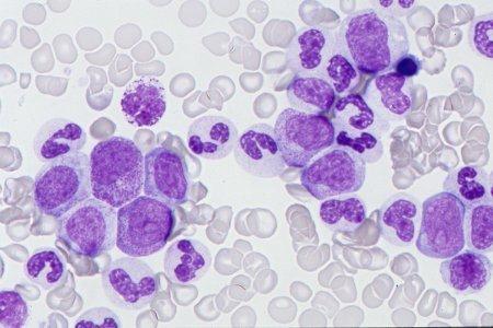 serta segmen. 4 Gambaran apusan darah tepi, dengan perbesaran 1000x menunjukkan tahapan granulocytic termasuk eosinofil dan basofil.
