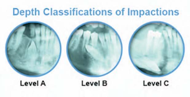 2.2.1 Berdasarkan radiografi Beberapa ahli mengklasifikasi gigi kaninus impaksi seperti berikut: 1.
