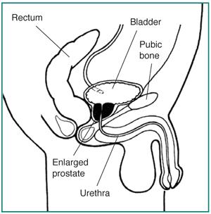 Aliran urin dengan BPH ETIOLOGI BPH terjadi karena proliferasi stroma dan epithelial dari glandula prostat yang sering didapatkan gejala voiding.